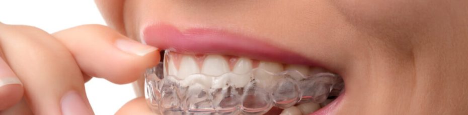 invisalign vs braces which is better