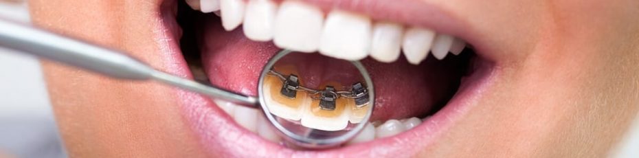 what are invisible braces