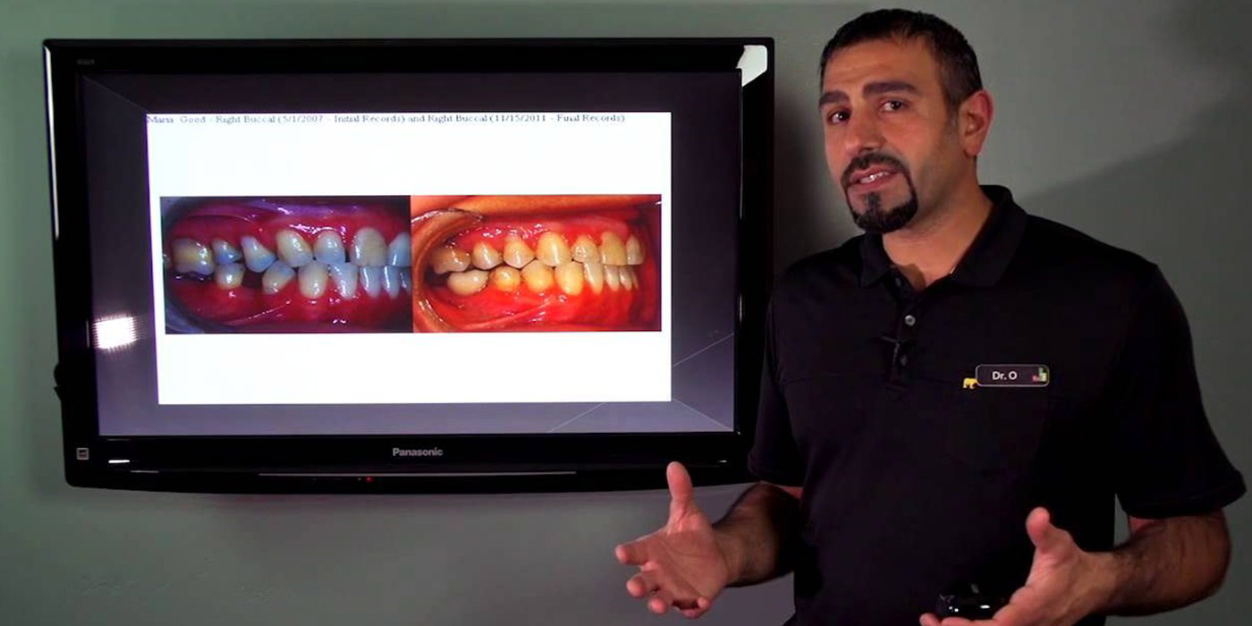 the basics of adult braces part 2