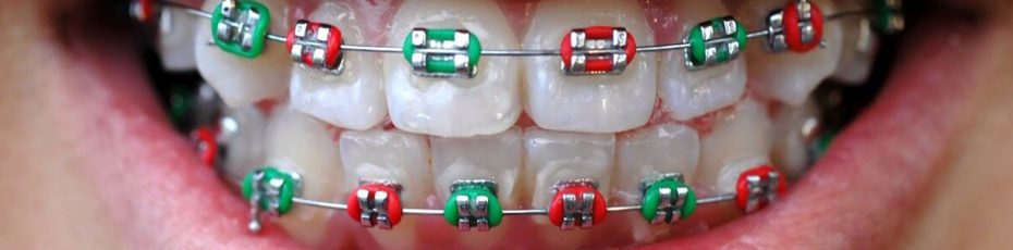 what color braces should you choose
