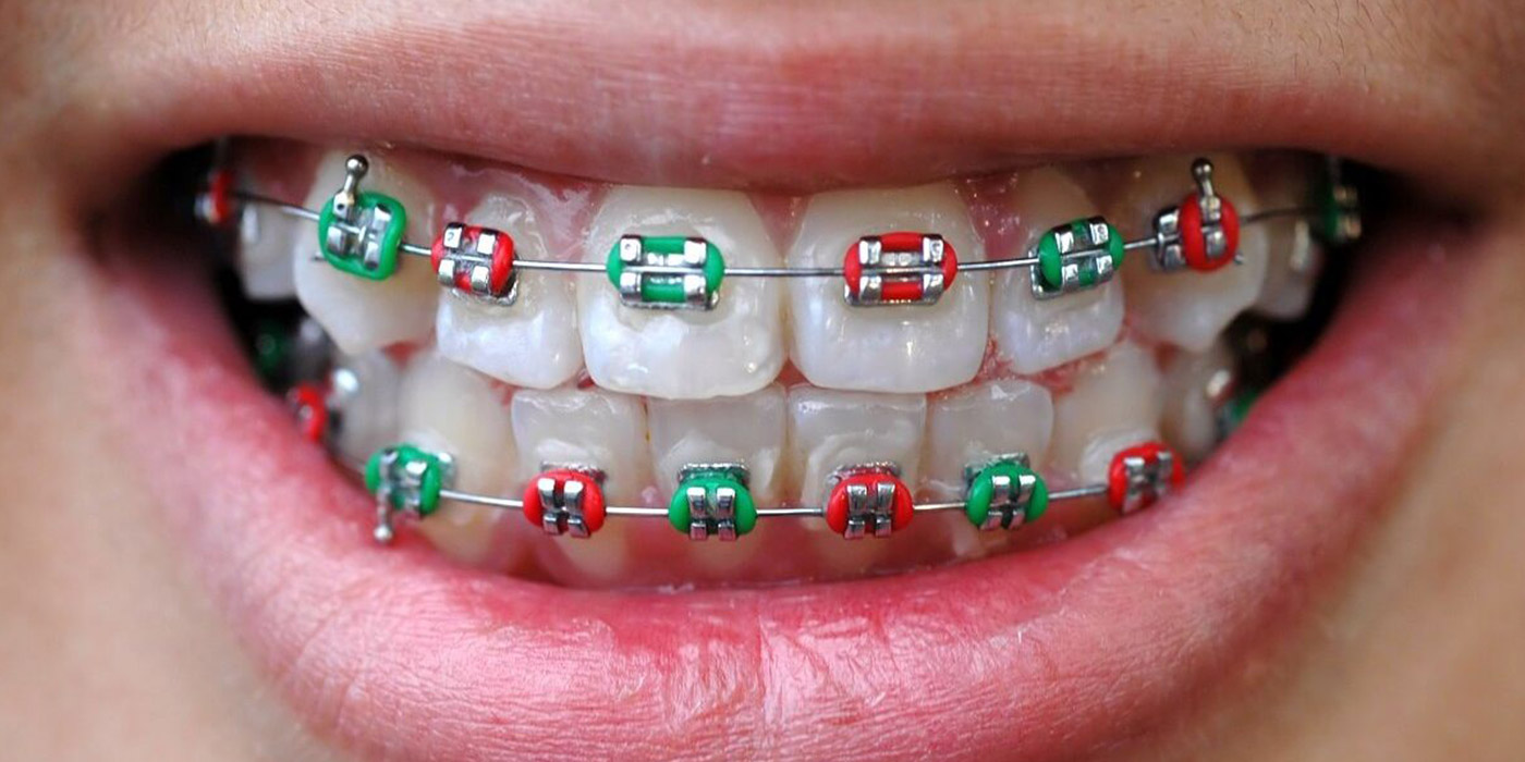 what color braces should you choose