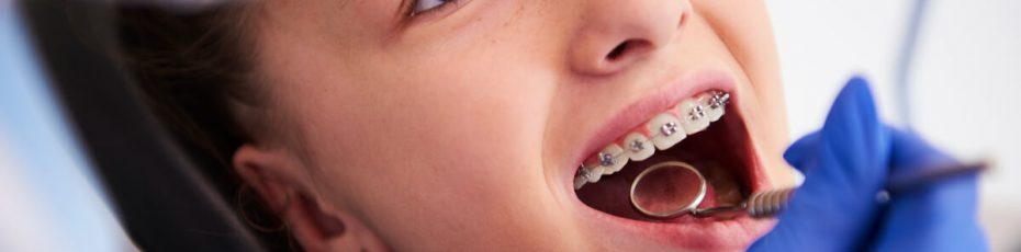 top tips for looking after your braces