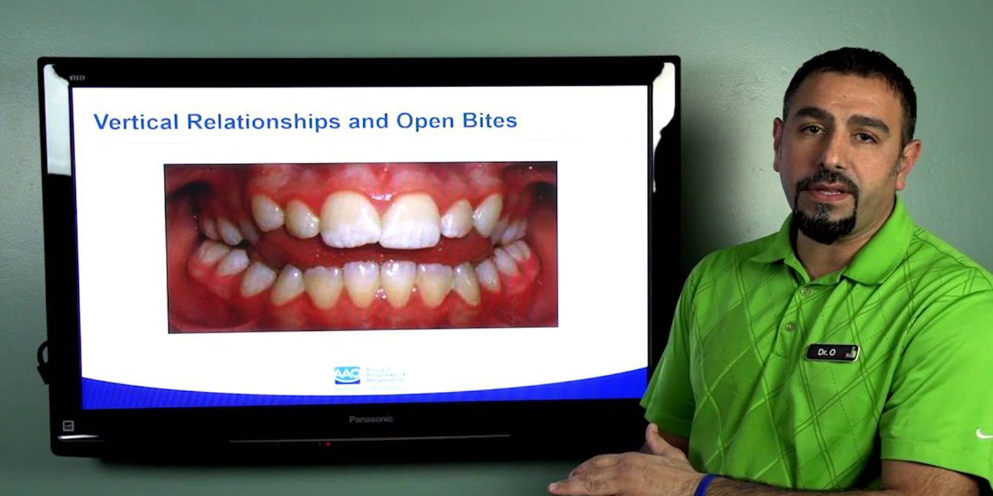 what is an open bite