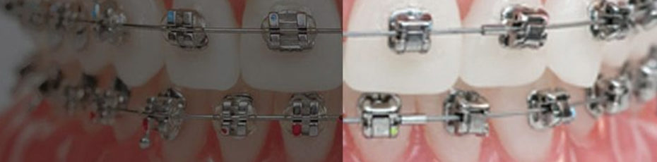 damon braces vs traditional braces