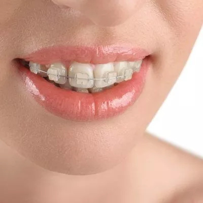 ceramic braces in chandler