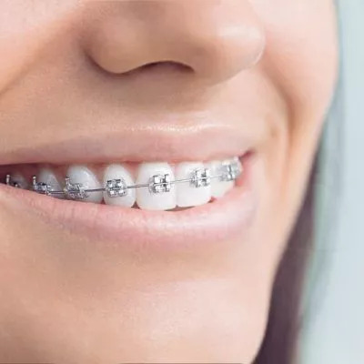 metal braces in peoria
