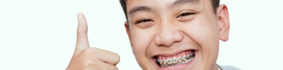 types of braces for adults, teens and children