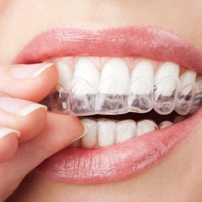 invisalign for adults in peoria invisalign for adults in peoria