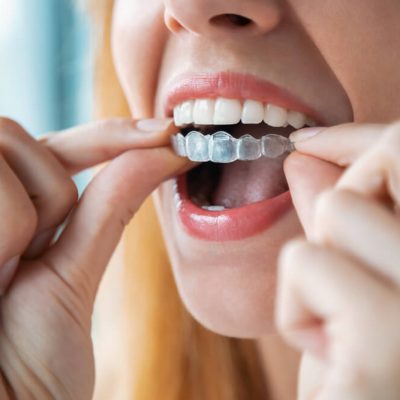 invisalign in chandler