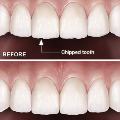 tooth re-shaping in peoria tooth re-shaping in peoria