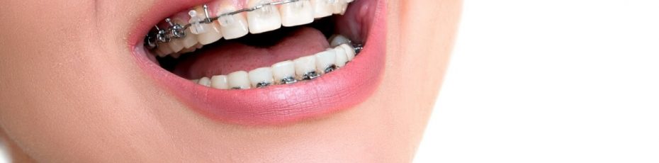 what are the alternatives to braces for adults