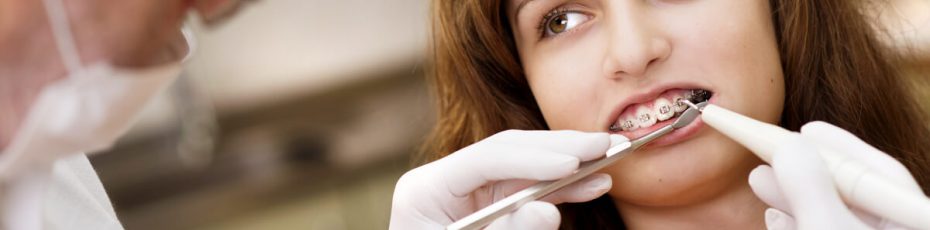 how damon braces can straighten your teeth faster