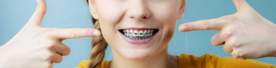 5 common misconceptions about braces